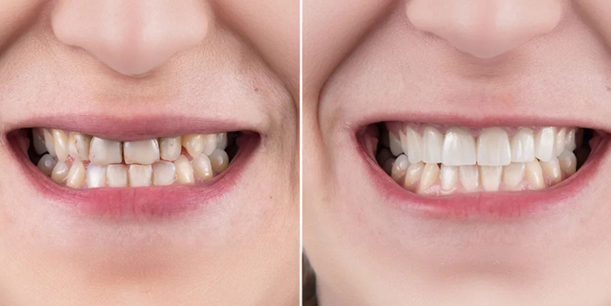 Porcelain veneers and whitening before and after Houston TX patient