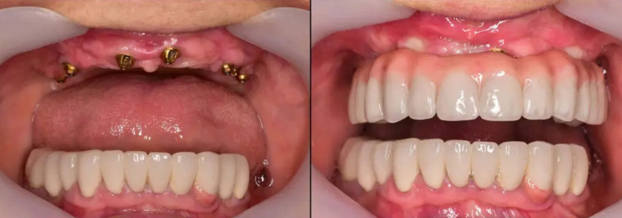 Dental implant restoration before and after Houston TX patient