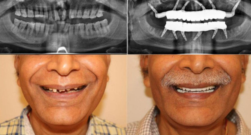 Full mouth rehabilitation before and after Houston TX patient
