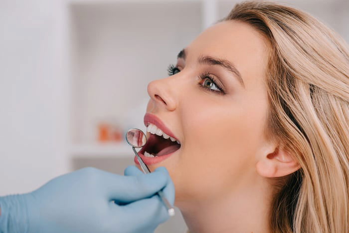 Smile makeover results with porcelain veneers and teeth whitening at Naba Dental Houston